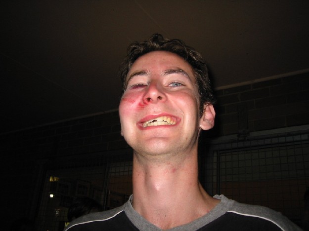 Damo's injuries.
